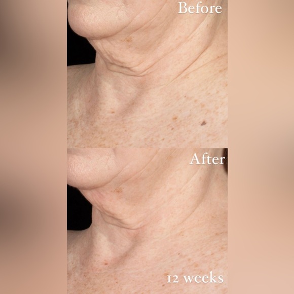 Obagi ELASTIderm Neck And Decollete Concentrate - Picture 2 of 4